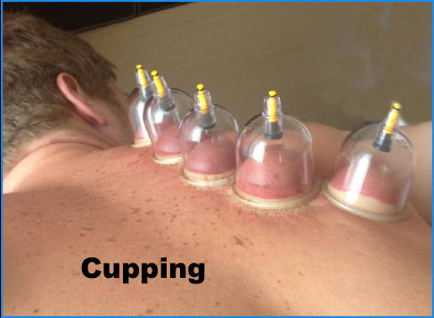 Cupping procedure